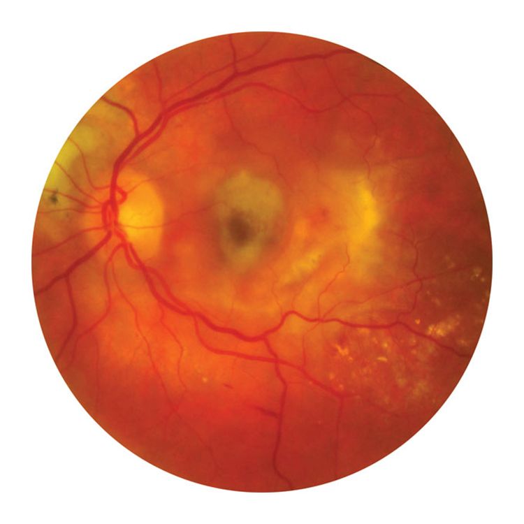 Drug Slows AgeRelated Macular Degeneration